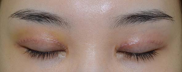 広すぎる二重 不自然な三重手術後7日目閉瞼 東京 日本橋 銀座エリアの皮膚科 美容皮膚科なら池本形成外科 美容外科