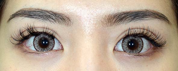 幅広平行二重切開手術後3か月メイクあり 東京 日本橋 銀座エリアの皮膚科 美容皮膚科なら池本形成外科 美容外科